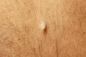 Giving basic treatment at home. How To Get Rid Of A Cyst Getridofthings Com