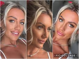 Rhinoplasty in Turkey