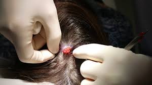 Keratin is the protein that makes up hair and nails. Benign Lesions Of The Eyelid Al Salem Eye Clinic