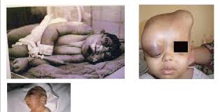 Yes, depleted uranium is radioactive, but it is not as radioactive as naturally occurring uranium as it is refined after mining the ore. The Effects Of Depleted Uranium Children Affected By Radiation And Download Scientific Diagram