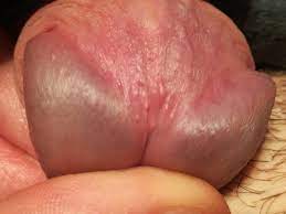 Tyson Glands Or Warts? Conflicting Diagnosis! (Pics) | Penis Disorders |  Forums | Patient