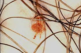 We did not find results for: Image Pubic Louse Msd Manual Consumer Version