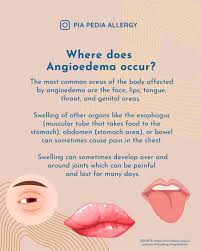 Image result for Angioedema