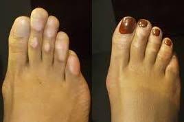 Corn Removal Before And After Toe Corn Removal Corn Removal Corn On Toe