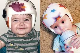 Ayudando a los bebés con plagiocefalia a través del tratamiento con casco  craneal