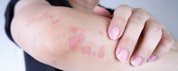 Image result for Vasculitis