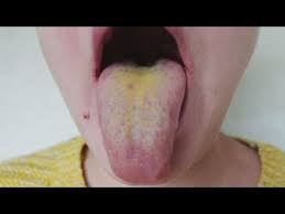 Image result for yellow tongue infection
