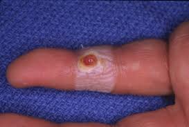 Image result for Pyogenic Granuloma