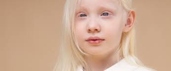 المهق البرص أسباب وأعراض وطرق علاج ويب طب