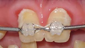 Wenn du zu wenig platz hast, wird ein backenzahn gezogen und dann mit einer zahnspange gerichtet. Zahnpflege Kieferorthopadie Lippstadt Dr Bianca Mertens