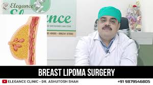 01 armpit fold incision method. Breast Lipoma Surgery Breast Surgery Surat Gujarat Navi Mumbai Maharashtra Madhya Pradesh Youtube