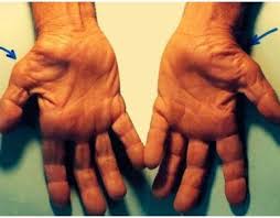 Carpal Tunnel Syndrome Writer S Cramp Spiritual Meaning Causes Carpal Tunnel Syndrome Carpal Tunnel Median Nerve