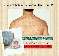 Wanita asal selandia baru itu menyadari ada sebuah jerawat di belakang telinga kanannya pada awal tahun 2018. Malu Kan Kalau Ada Jerawat Kat Belakang Jsd Jamu Susuk Dara Malaysia Facebook