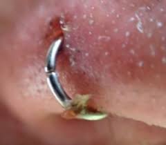 Infected Nose Ring Signs Nose Piercing Bump Nose Piercing Piercing Bump