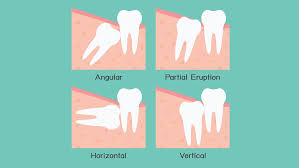 We did not find results for: Know The Warning Signs Of Impacted Wisdom Teeth Dental On Clarendon