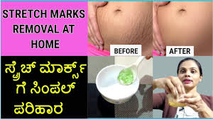 ಕೇವಲ 5 ದಿನದಲ್ಲಿ ಸ್ಟ್ರೆಚ್ ಮಾರ್ಕ್ಸ್ ...