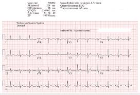 Image result for Synchronized Cardioversion