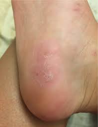 See full list on mayoclinic.org How To Remove Plantar Warts Naturally Artsea Chic
