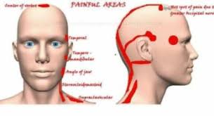 Headache Location Arşivleri Types Of Headaches Types Of