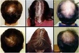 Heilongjiang university of traditional chinese medicine second affiliated hospital researchers compared results in a clinical trial. Derma Rolling For Hair Restoration