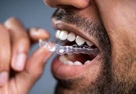 We did not find results for: Should You Use A Dental Mouthguard For Your Jaw Pain Cleveland Clinic
