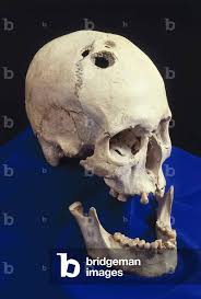 Image result for Skull Trephination