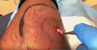 Ingrown hairs may be caused by improper what is an ingrown hair? Ingrown Hair Infection Drainage On The Leg New Pimple Popping Videos