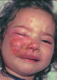 Forum: Recherche in PädInform Fortbildung: Herpes Zoster Berufsfragen:  Priorisierung oder Rationalisierung Magazin: Wie es dazu