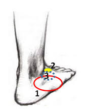 Por Donde Te Duele El Pie Dolor De Pies Al Correr Y Caminar