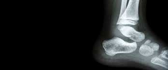 Image result for Ankle XRay