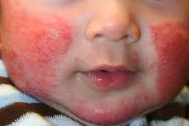 Banyak orang jika sudah mengalami siku yang kering tak sengaja akan mengupasnya. Bidara Lab Apakah Eczema Ekzema Eczema Ialah Kondisi Kulit Yang Kering Dan Gatal Eczema Di Kalangan Kanak Kanak Selalu Ternampak Buat Pertama Kali Sebelum Anak Berusia Dua Tahun Berita Baik Ialah
