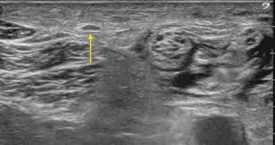 Maybe you would like to learn more about one of these? Posterior Femoral Cutaneous Nerve Block Sciencedirect