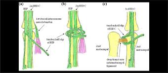 Image result for Elson Extensor Tendon Test