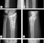 Dorsal (AO/ASIF) Pi-plate Osteosynthesis in the Treatment of ...