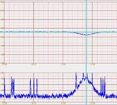 Image result for FHR Variability