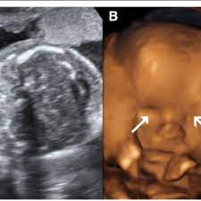 Pdf Prenatal Diagnosis And Implications Of Microphthalmia And Anophthalmia With A Review Of Current Ultrasound Guidelines Two Case Reports