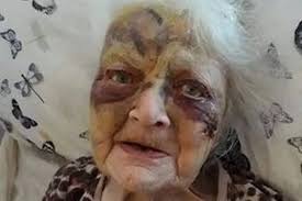 Grieving family search for answers after gran suffered serious facial  injuries at care home