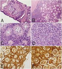 metastatic prostate cancer in bladder. Metastatic Prostatic Carcinoma To Testis Histological Features Mimicking Lymphoma Abstract Europe Pmc
