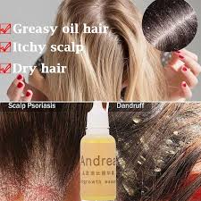 Each of these hair types is a combination of an individual's anatomy and nature but some external factors diet, weather, and stress, etc. Hair Care Anti Dandruff Strong Antipruritic Hair Treatment Products Dermatitis Hair Dandruff Repair Buy At A Low Prices On Joom E Commerce Platform