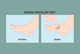 Image result for Edema Exam