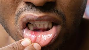 Image result for Oral herpes roof of mouth