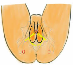 Image result for Pudendal Block