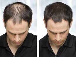 Laser therapy as a hair loss treatment today, low level laser therapy is being used as a hair loss treatment. Methods Of Hair Loss Treatment For Men Yusrablog Com