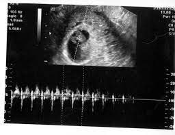 bebegin kalp atisinin duyulmama nedenleri ve gelisimi