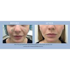 Pluryal Contour Lidocaine