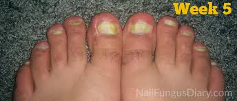 In this post, we have listed prevention & remedies to treat nail tea tree oil can be used to treat onychomycosis. Does Tea Tree Oil Really Kill Nail Fungus Nailstip
