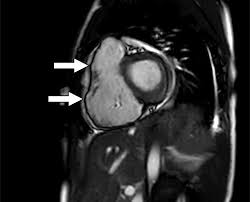 Image result for Cardiac MRI