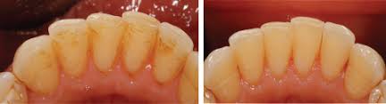 Zahne Bleichen Bleaching Dental Team Dr Hajto Munchen