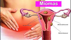 El uso de ambos instrumentos le proporciona al médico dos perspectivas de un fibroma uterino, lo que permite un tratamiento más riguroso del que sería posible con una sola perspectiva. Tratamiento No Invasivo Para Fibromas Uterinos Es Mas Seguro Y Tan Efectivo Como La Cirugia
