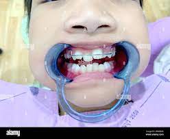 The Asian girl open her mouth with mouth gag and show removable appliance  with anterior spring braces because of anterior cross bite at Pranburi  hospi Stock Photo - Alamy